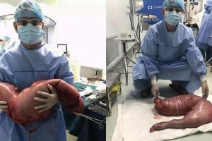 Pria ini sembelit bertahun-tahun, ternyata ada 13 kg tinja di ususnya