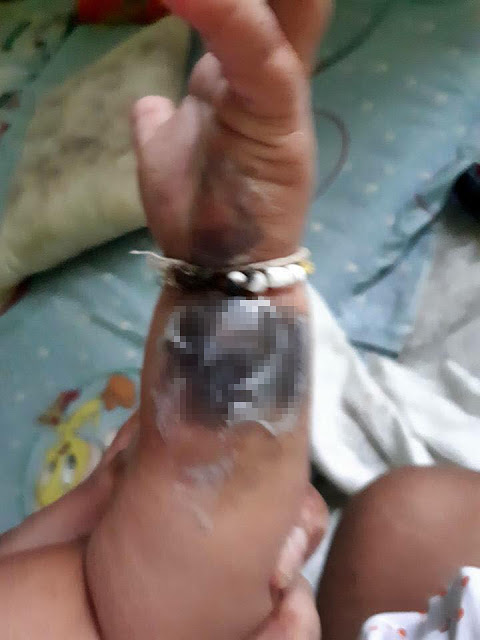Gelang tangan masuk ke colokan listrik, bayi ini alami luka bakar
