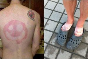 10 Pola kulit belang akibat terbakar sinar matahari ini kocak