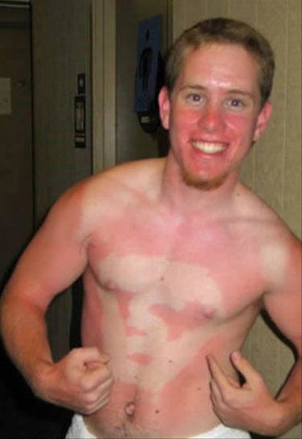 10 Pola kulit belang akibat terbakar sinar matahari ini kocak