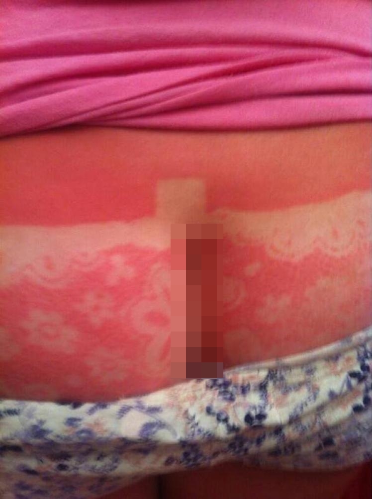 10 Pola kulit belang akibat terbakar sinar matahari ini kocak