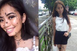 Tubuh dipenuhi tahi lalat, gadis ini justru malah jadi inspirasi
