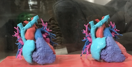 Cacat jantung bawaan, bayi ini sembuh berkat teknologi mutakhir USG