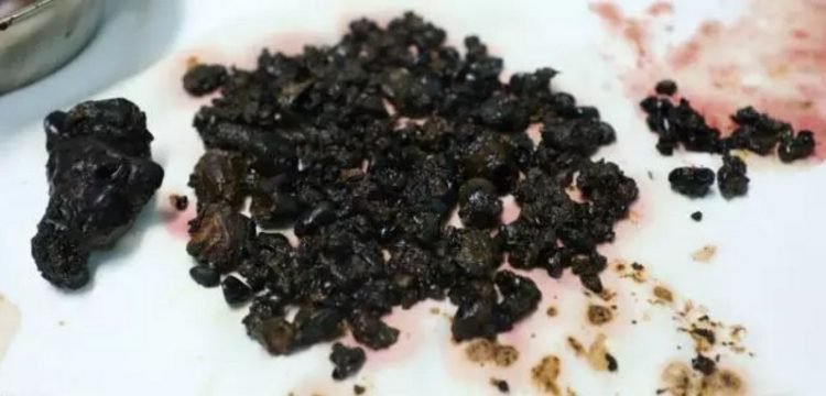 Dokter temukan 200 batu dalam tubuh wanita ini, ada yang sebesar telur