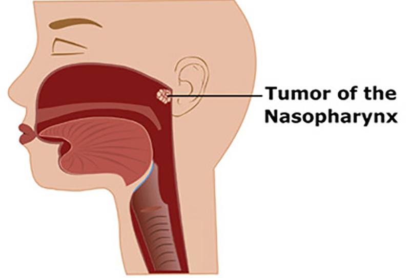Didiagnosa menderita kanker nasofaring, ini kabar terkini Kim Woo-bin