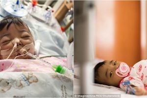 Derita penyakit langka, bayi ini ditinggal orangtuanya di rumah sakit