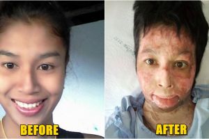 Gara-gara selfie, tubuh wanita ini dibakar suaminya yang cemburu buta