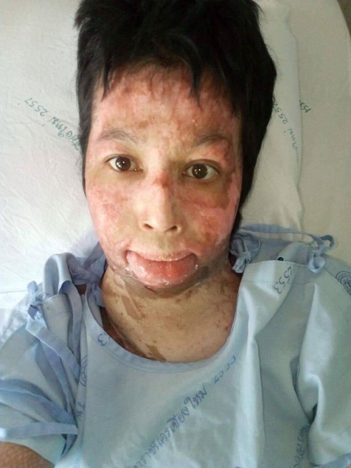 Gara-gara selfie, tubuh wanita ini dibakar suaminya yang cemburu buta