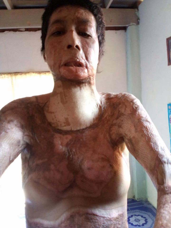 Gara-gara selfie, tubuh wanita ini dibakar suaminya yang cemburu buta
