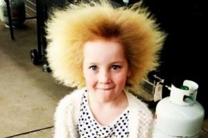 6 Orang ini alami penyakit aneh, rambutnya berdiri & tak bisa disisir