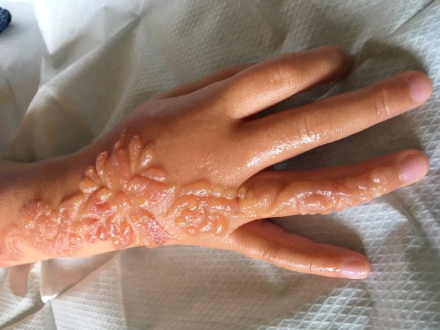 Pakai henna hitam, kulit tangan gadis 7 tahun ini melepuh
