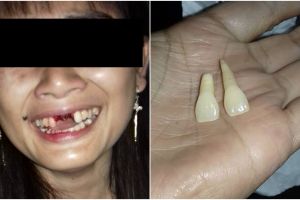 Gigi rontok ditendang suami, curhatan wanita ini bikin terenyuh