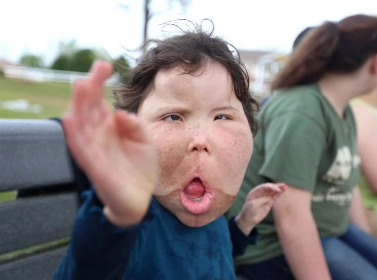 Dokter sampai bingung obati anak ini gara-gara idap penyakit langka