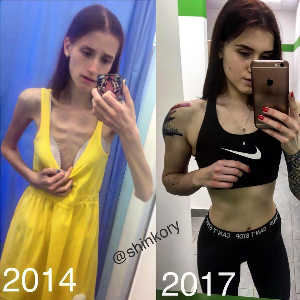 Dulu hanya 'kulit dan tulang', transformasi gadis ini bikin takjub