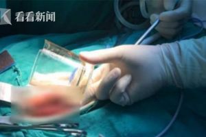 Dokter temukan gelas kaca di dalam pantat pria, alasannya bikin syok