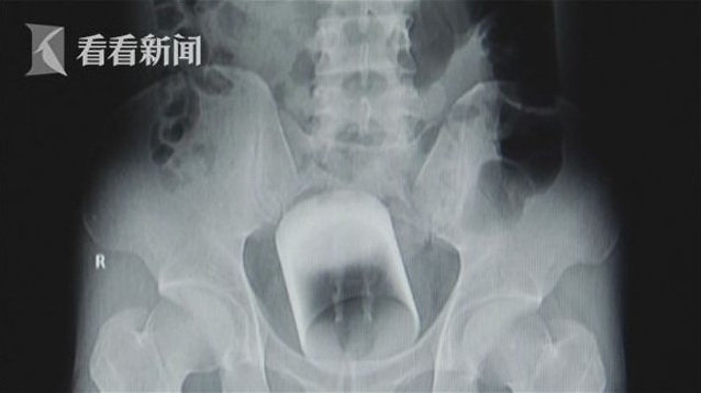 Dokter temukan gelas kaca di dalam pantat pria, alasannya bikin syok