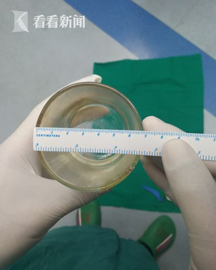 Dokter temukan gelas kaca di dalam pantat pria, alasannya bikin syok