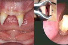 8 Kasus aneh seputar gigi, ada yang tumbuh di mata