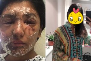 Wajah kena air keras, perubahan cewek ini usai operasi bikin takjub