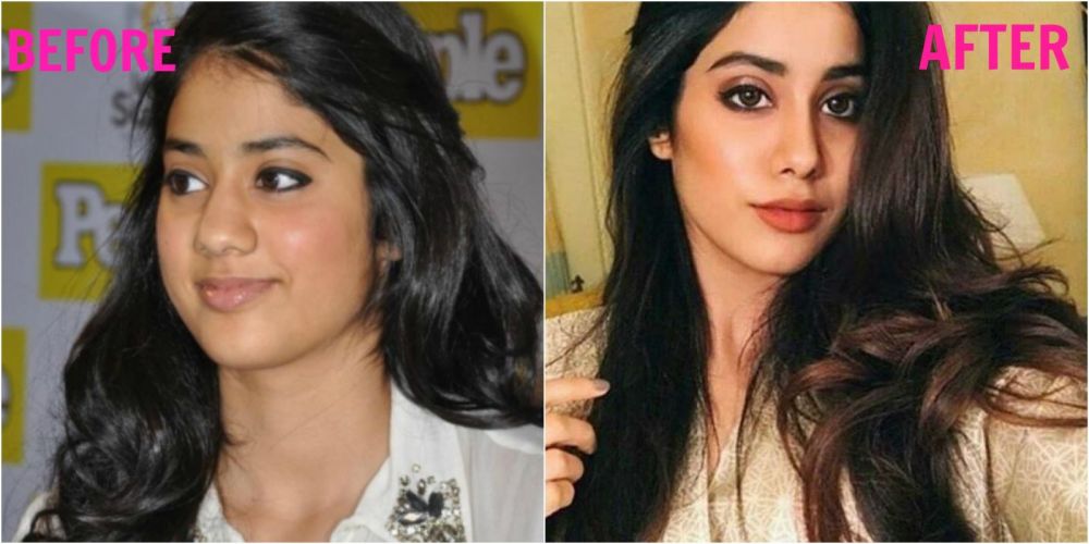 6 Seleb Bollywood ini ketahuan lakukan oplas hidung, tambah mancung