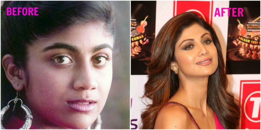 6 Seleb Bollywood ini ketahuan lakukan oplas hidung, tambah mancung