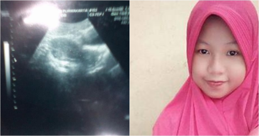 Curhatan pilu wanita yang rahimnya terinfeksi usai suntik KB 3 bulan