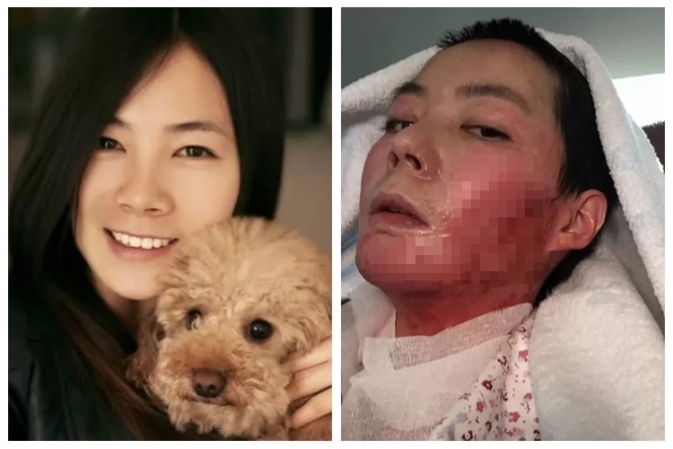 Kisah tragis wanita yang disiram alkohol & dibakar suaminya