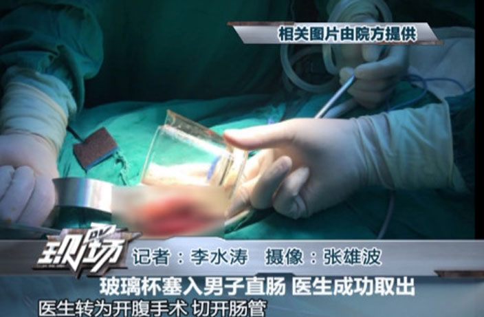 5 Benda tak biasa yang bersarang dalam dubur manusia, ada 1 kg emas