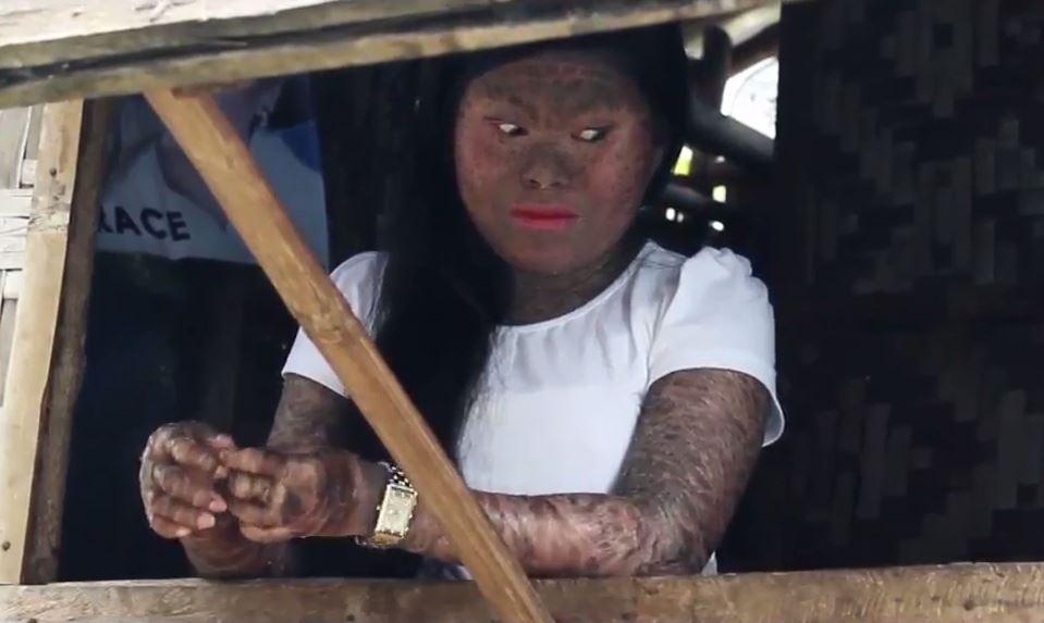 Derita penyakit langka, gadis ini miliki kulit bersisik seperti ular