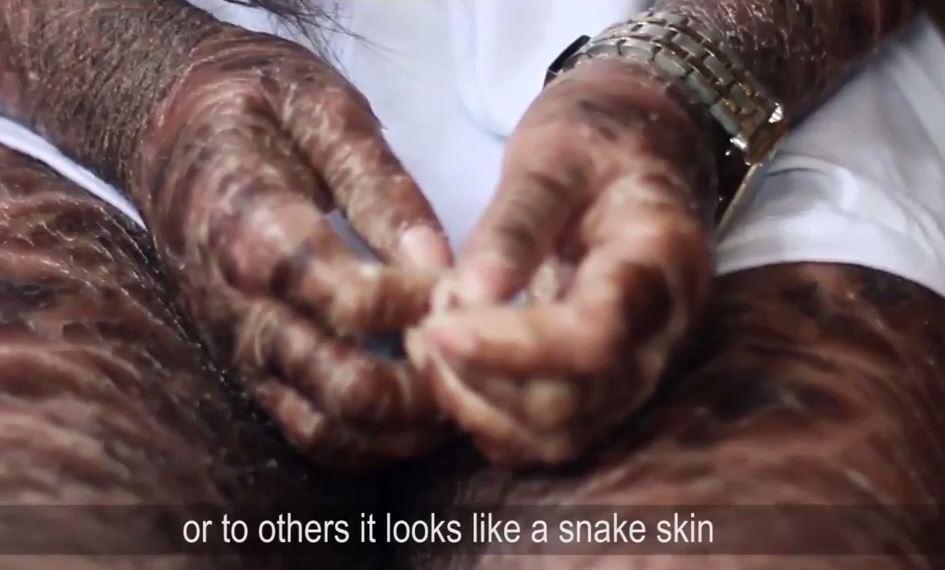 Derita penyakit langka, gadis ini miliki kulit bersisik seperti ular