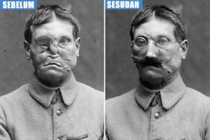 11 Wajah rusak tentara korban PD I, bukti perang tak perlu ada lagi