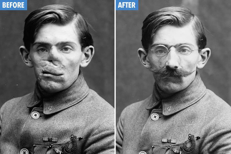 11 Wajah rusak tentara korban PD I, bukti perang tak perlu ada lagi