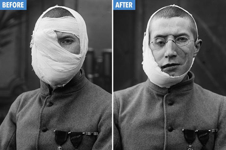 11 Wajah rusak tentara korban PD I, bukti perang tak perlu ada lagi