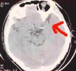 3 Hari nonstop main game online, mahasiswa ini stroke mendadak
