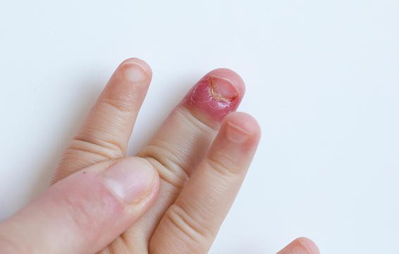 7 Akibat fatal di balik kebiasaan gigit kuku, bisa sampai membusuk
