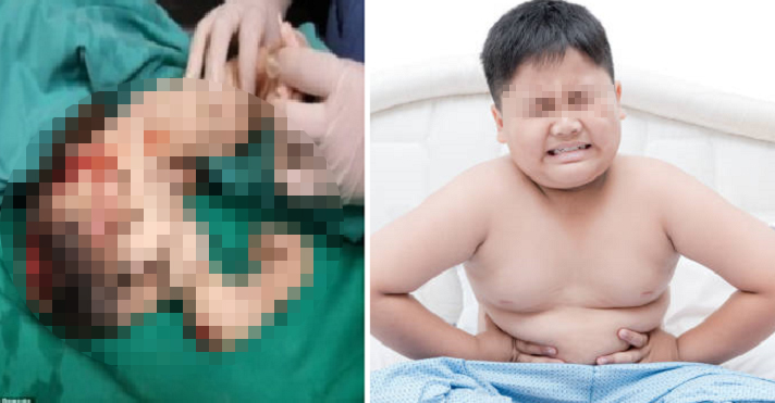 Sering mengeluh sakit perut, dokter temukan janin di tubuh bocah ini