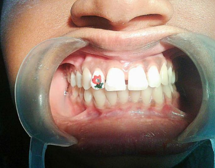 10 Kreasi tato unik di gigi, kamu berani coba?