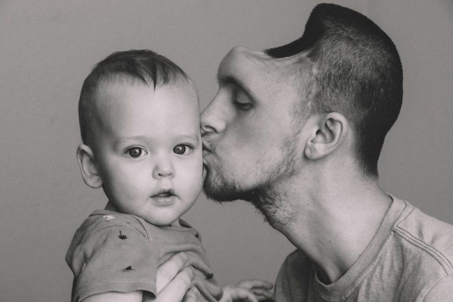 Curhatan pilu istri dampingi suami yang kehilangan kepala bagian depan