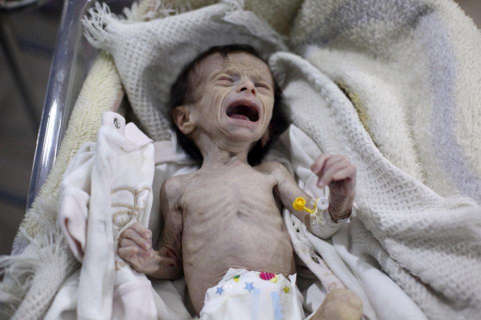 4 Potret bayi gizi buruk akibat perang ini bikin hatimu teriris