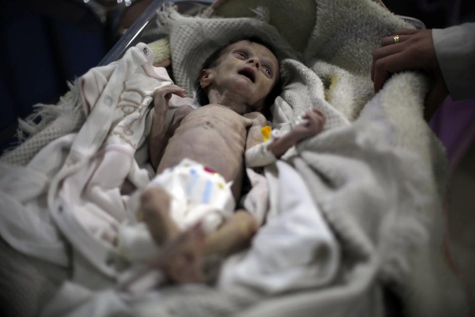 4 Potret bayi gizi buruk akibat perang ini bikin hatimu teriris