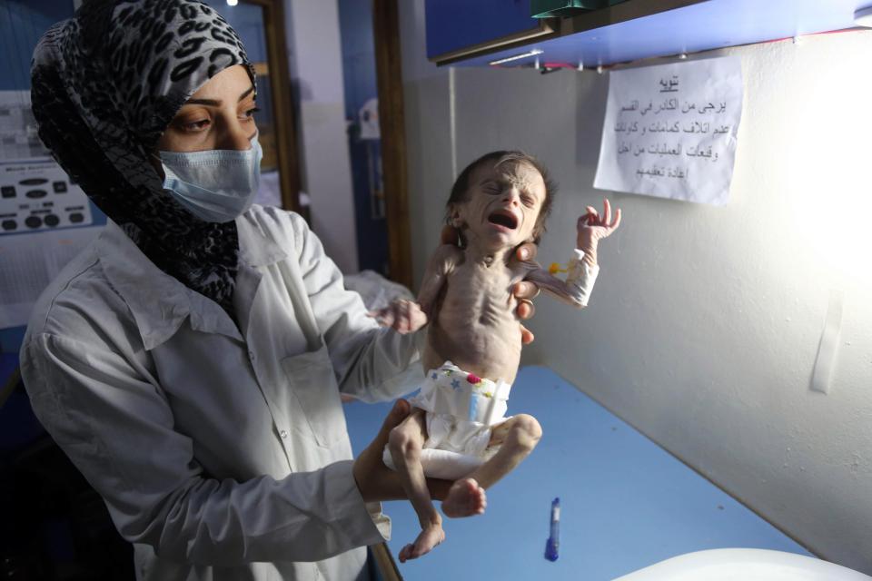 4 Potret bayi gizi buruk akibat perang ini bikin hatimu teriris