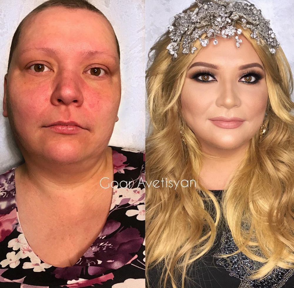 Transformasi ajaib makeup 10 cewek penderita kanker & kelainan kulit
