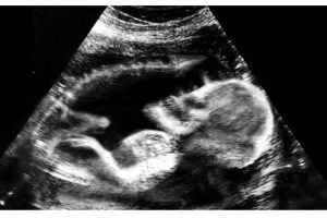 7 Penampakan seram hasil pemeriksaan USG ini bikin merinding