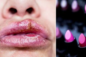 Bibir cewek ini kena herpes setelah pakai lipstik, kok bisa?