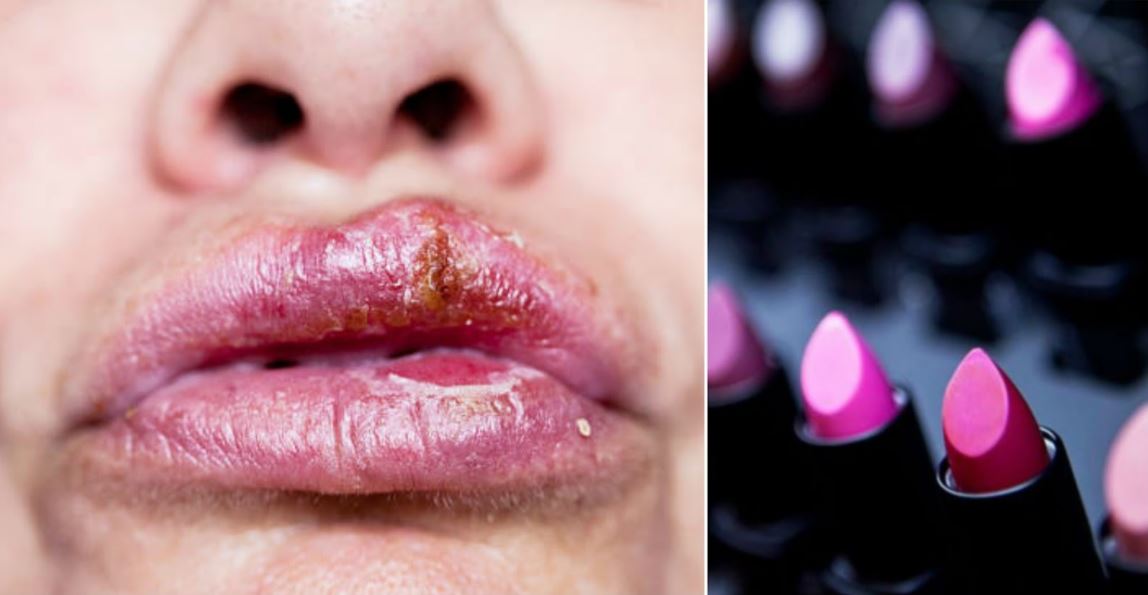 Bibir cewek ini kena herpes setelah pakai lipstik, kok bisa?