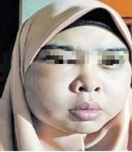 Pakai produk kecantikan yang dibeli online, wajah wanita ini bengkak 