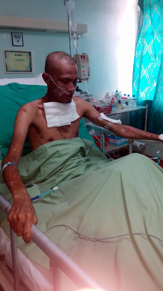 Kisah setia sang istri merawat suami yang kulit tubuhnya mengelupas