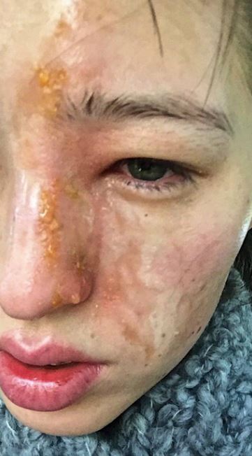 Kesemprot parfum ruangan, wajah wanita ini rusak dalam waktu 10 menit