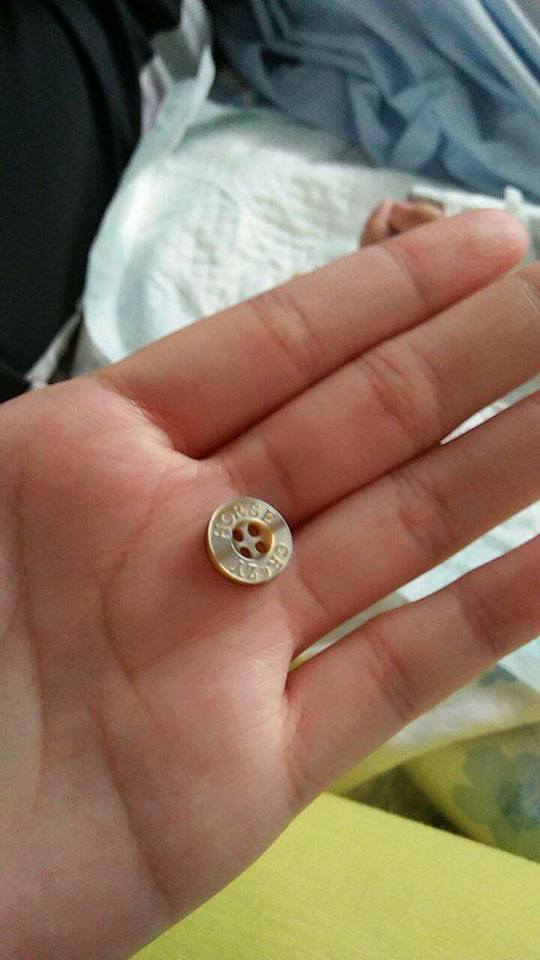 Ibu ini terkejut lihat benda aneh tersangkut di hidung putrinya