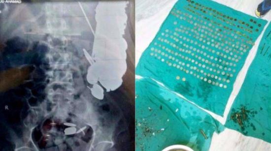 Dikira keracunan, isi perut pria ini ternyata paku dan koin